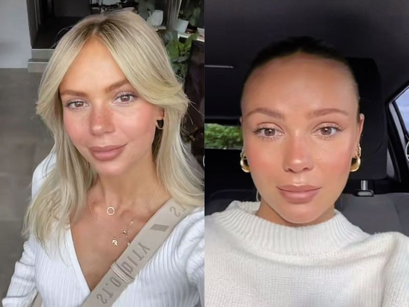 Tiktok Userin zeigt vor und nachher ihrer Baby botox behandlung