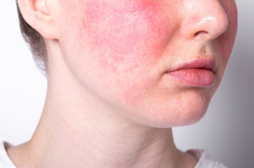 Frau mit Rosacea